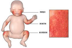 Алергия към прах за пране детето симптоми, лечение (снимка)