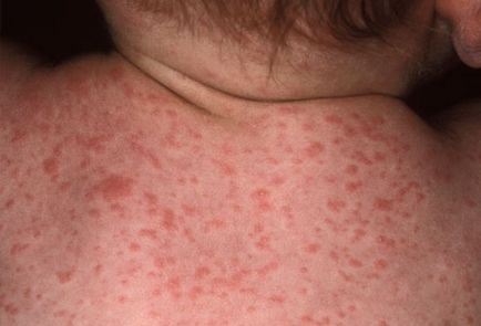 Алергия към прах за пране при възрастни и деца - снимка на алергична реакция