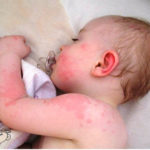 алергични към вода от чешмата причините и симптомите на алергията