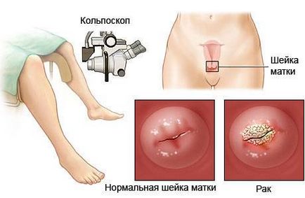 маточната шийка биопсия