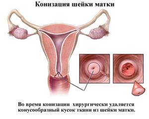 маточната шийка биопсия