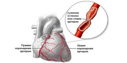 Мозъчно заболяване, горните и долните крайници симптоми, диагностика и лечение