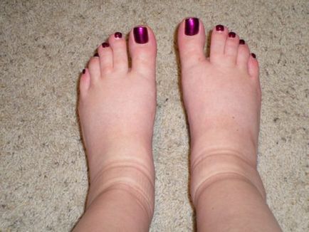 Заболявания на съдове на краката 8 на симптомите, които правят звъни