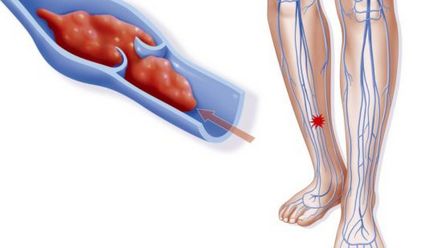 Заболявания на съдове на краката 8 на симптомите, които правят звъни