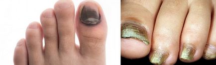 Почернели нокти причиняват, как да се справят с почернял нокът, здравословни проблеми