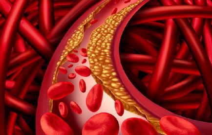Какво е кръвен съсирек счупи защо, симптоми, как да се разпознават, че разрежда кръвта