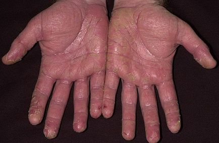 Cuhaya екзема на ръцете, отколкото лечение - подробности