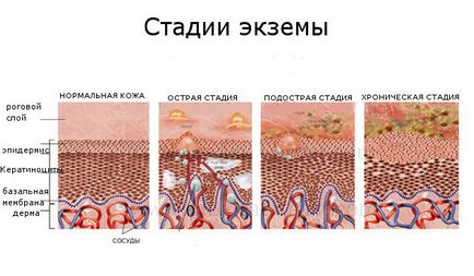 Cuhaya екзема на ръцете, отколкото лечение - подробности