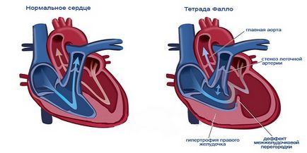 Схема сърцето ос отклонение, позицията на вертикални и хоризонтални
