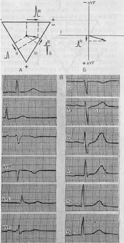 Хоризонталното положение на електрическата ос на сърцето - анатомична и физиологична основа