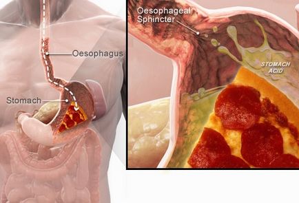 Как бързо премахване на киселини в стомаха като у дома си - от това е по-добре да се премахне