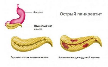 Как боли панкреаса при хора основните симптоми