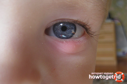 Как за лечение на ечемик на окото в детето 1