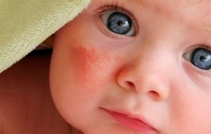 Откъде знаеш, че детето има алергия към прах за пране