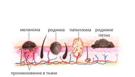 Като у дома си, за да се отстранят папиломи аптека и народни средства