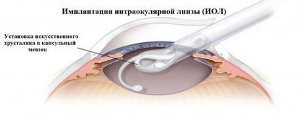 Как да се възстанови зрението у дома, за да се възстанови за 1 ден