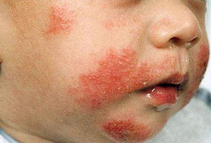 Какво е алергия при кърмачета в праха