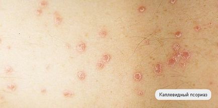 Какво е херпес зостер имат снимки човешки симптоми (заболяване) Какво е херпес зостер имат снимки симптоми заболявания при човека