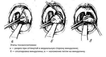 Лечение на гноен тонзилит, отколкото лекува най-бързо излекувани народни средства