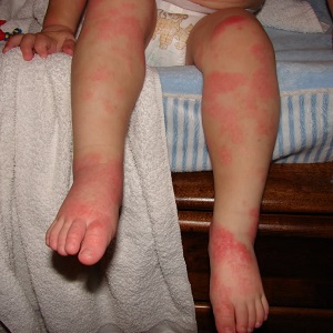 Лечение и симптоми на алергия към прах за пране при дете - всичко за алергии