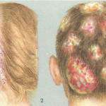 Тения при хора симптоми, снимка, лечение за лишаване на лицето