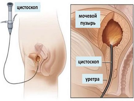 Урина с кръв и болка по време на уриниране при мъжете