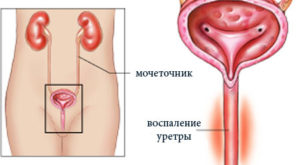 Урина с кръв в жените каузи