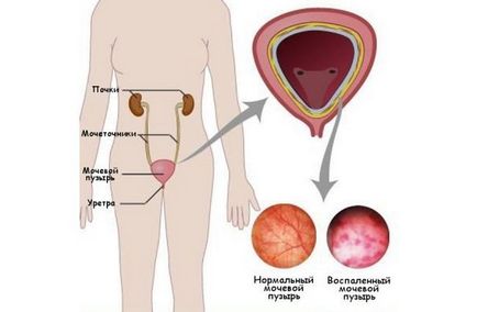 Урина с кръв жените - причини и лечение