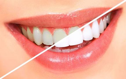 Избелване на зъби народната медицина, здравни рецепти