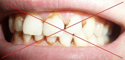 Избелване на зъби у дома, без да вреди на емайла