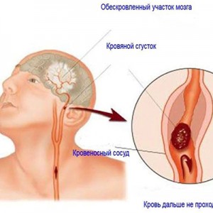 От които се образуват кръвни съсиреци, trombanet