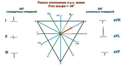Ос отклонение наляво диагноза тактиката (остър ос отклонение на ляво) Ос отклонение наляво диагноза тактики