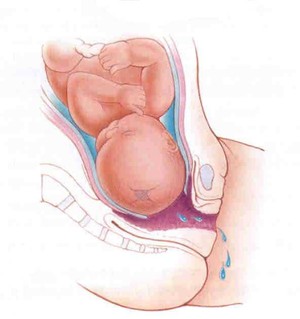 Освобождаване от отговорност на слуз щепсел преди раждането, че трябва да се разбира по време на бременност, тъй като се отклонява и