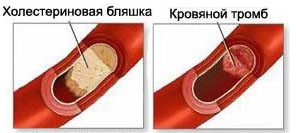 Защо боли крак под коляното причинява заболяване, лечение