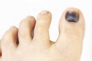 Защо почернелите ноктите на краката - моят живот