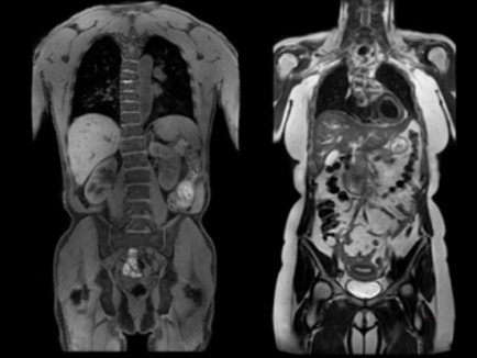 Получаване на MRI на коремната кухина и органите на перитонеална пространство