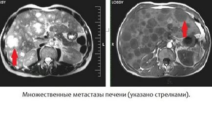 Подготовка за коремни MRI особености, които трябва да се обърне внимание