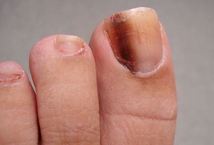 Тъмните пирони на големия пръст на крака - причини и лечение