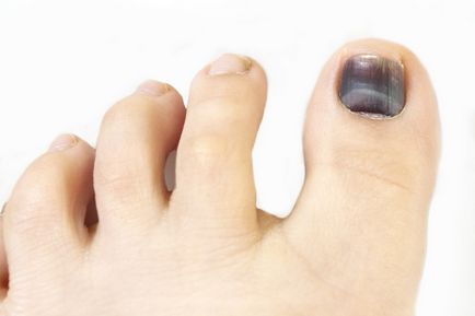 Тъмните пирони на големия пръст на крака - причини и лечение