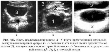 Простатит капитация диагноза