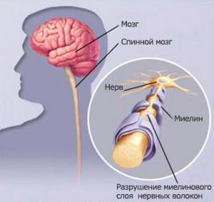 Множествената склероза лечение на народната медицина, причинява на жените