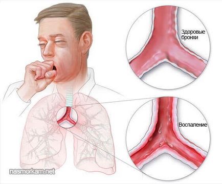 Решения и небулизатори инхалатори за лекарства за кашлица