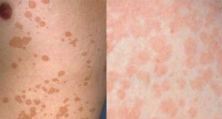 Pityriasis лишей - снимка при хора, лечение, лекарства