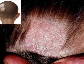 Pityriasis лишей - снимка при хора, лечение, лекарства (снимка) Pityriasis лишей - снимка при хора, лечение, лекарства