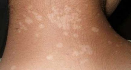 Pityriasis лишей - снимка при хора, лечение, лекарства