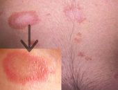 Pityriasis лишей - снимка при хора, лечение, лекарства