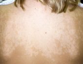 Pityriasis лишей - снимка при хора, лечение, лекарства