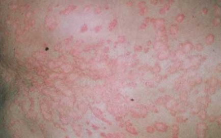 Pityriasis лишей - снимка при хора, лечение, лекарства