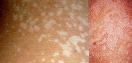 Pityriasis лишей - снимка при хора, лечение, лекарства (снимка) Pityriasis лишей - снимка при хора, лечение, лекарства