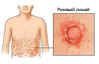 Розови херпес симптоми и лечение на заболяването